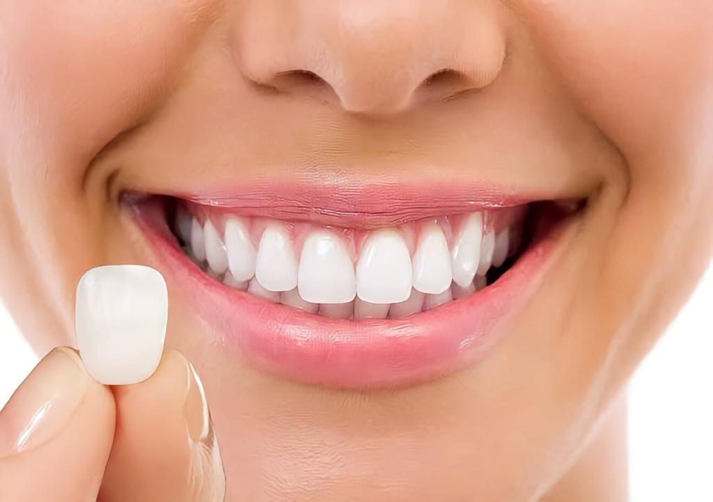 Lentes de Porcelana e Facetas